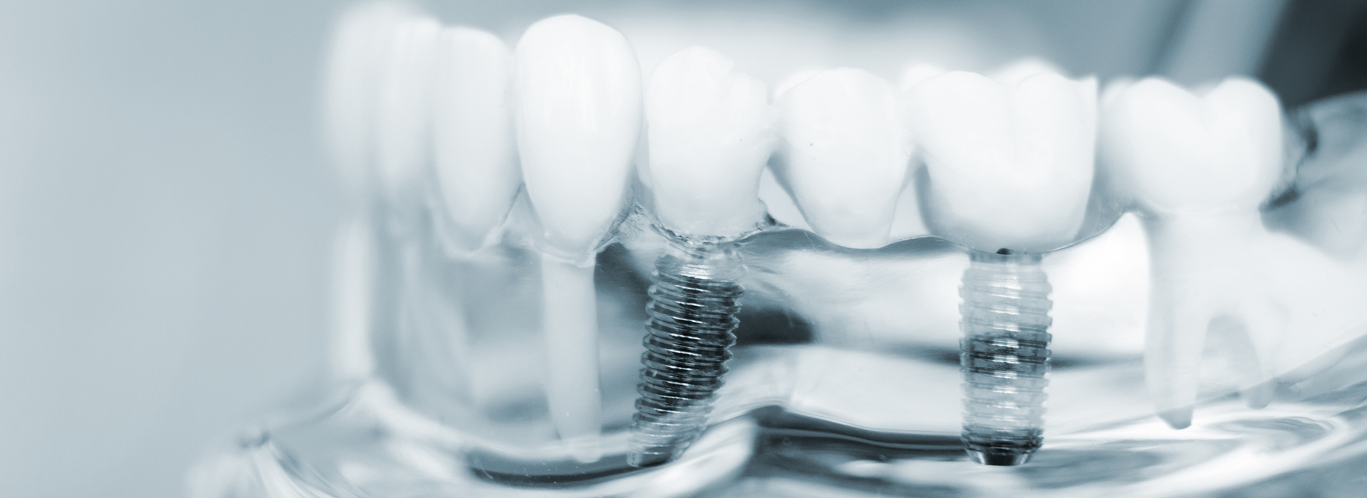 A close-up of a transparent dental implant with screws and a dental crown, showcasing the intricate details of dental technology.