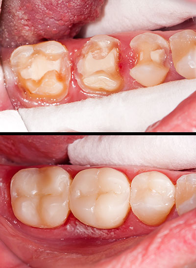 Before and after dental treatment  a comparison of two images showcasing the transformation from an unhealthy mouth to one that has received professional care.