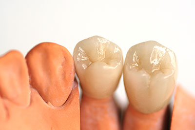 Close-up of two artificial teeth with a visible root structure, set against a white background.