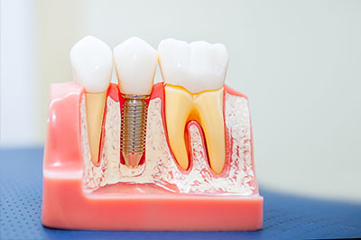 An image of a dental model with artificial teeth, showcasing the process of dental implantation or restoration.