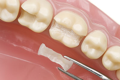 A dental model with a missing tooth, showcasing the process of dental implantation.