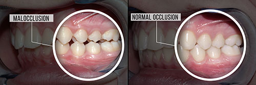 The image displays two photographs of a person s mouth, showing teeth with various stages of dental work.