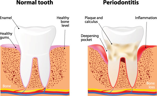 The image is a medical illustration showing the progression of tooth decay from normal to severe, with annotations indicating different stages and causes.