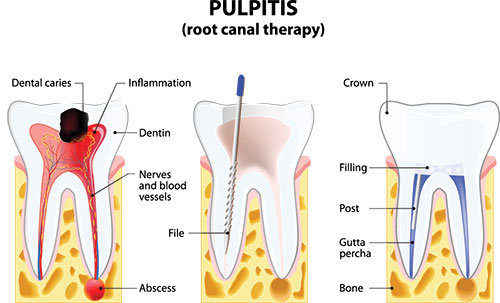 The image is a medical illustration depicting the process of pulpitis, showing the root canal therapy with anatomical labels and a step-by-step sequence.