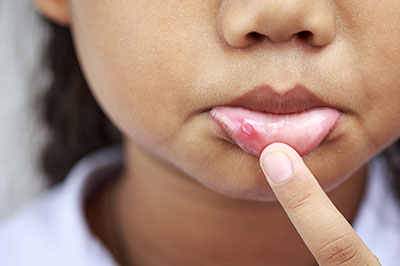 The image features a close-up of a young child s face, with a focus on the lips which appear to be affected by a condition that causes swelling or redness.