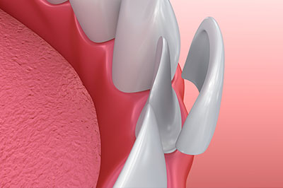 An image of a dental implant with a focus on the surrounding gum tissue and pinkish-reddish color, set against a plain background.