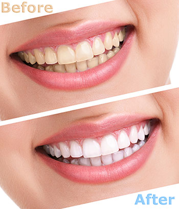 The image shows a smiling person before and after teeth whitening, with text indicating the transformation.
