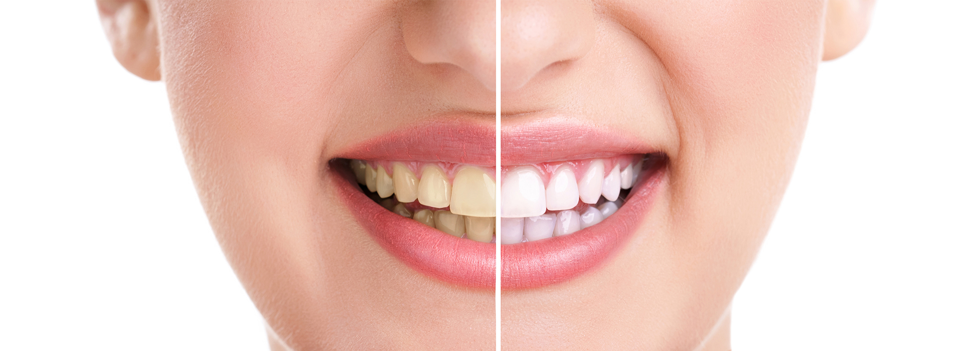 The image shows a close-up of a smiling person with teeth whitening treatment applied, demonstrating the before and after effect.